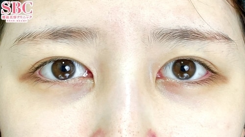 {フォーエバー二重術} {20代}  {女性} の術前の症例写真