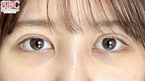 {フォーエバー二重術} {20代}  {女性}  の術後の症例写真