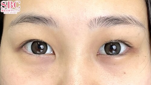 {フォーエバー二重術} {20代}  {女性} の術前の症例写真