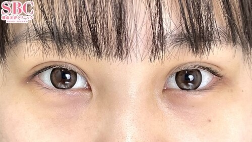 {フォーエバー二重術} {20代}  {女性}  の術後の症例写真