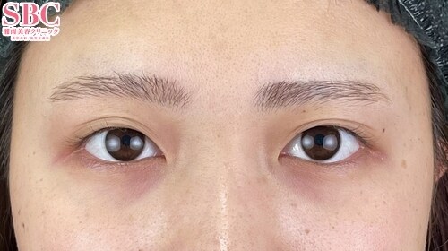 {クイックコスメティークダブルNeo} {30代}  {女性} の術前の症例写真