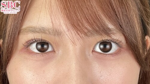 {クイックコスメティークダブルNeo} {30代}  {女性}  の術後の症例写真