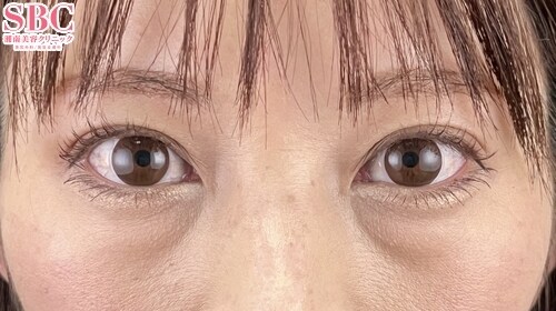 {クイックコスメティークダブルNeo} {30代}  {女性}  の術後の症例写真