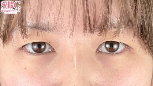 {クイックコスメティークダブルNeo} {20代}  {女性} の術前の症例写真