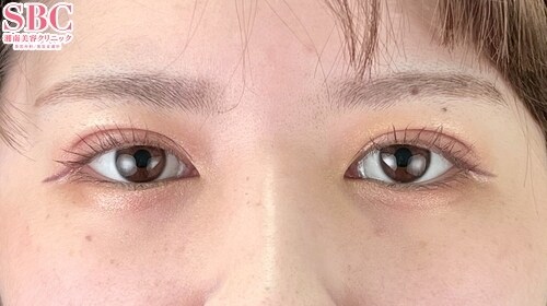 {クイックコスメティークダブルNeo} {20代}  {女性}  の術後の症例写真