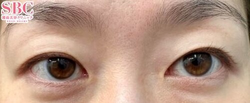 週末二重 症例写真1 Before