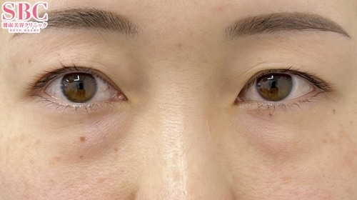 クマ取り 症例写真1 Before