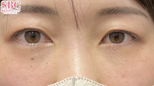 クマ取り 症例写真1 After