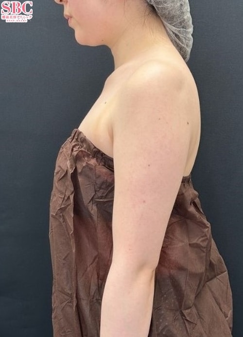 {脂肪吸引} {30代}  {女性} の術前の症例写真