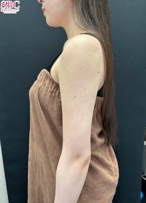 {脂肪吸引} {30代}  {女性} の術後の症例写真