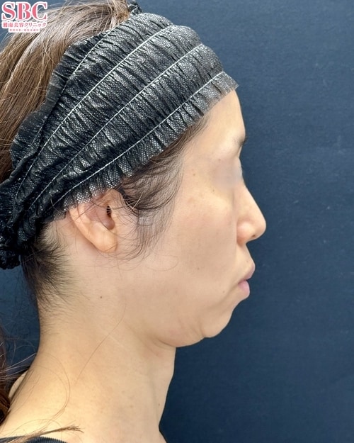 {脂肪吸引} {30代}  {女性} の術前の症例写真
