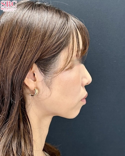 {脂肪吸引} {30代}  {女性} の術後の症例写真