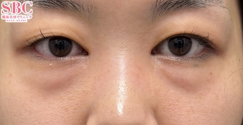 クマ取り 症例写真2 Before
