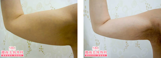 竹田啓介 医師|美ボディ脂肪吸引|施術前後の症例写真