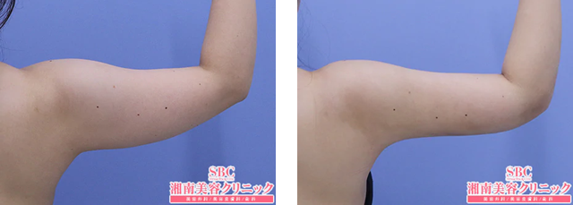 水口将志 医師|美ボディ脂肪吸引|施術前後の症例写真