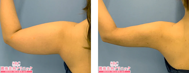 葛島魁人医師|根こそぎVASER脂肪吸引|施術前後の症例写真