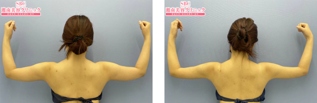 葛島魁人医師|根こそぎVASER脂肪吸引|施術前後の症例写真