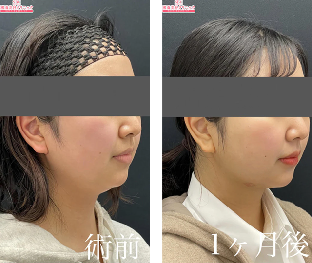 岩本優輝医師｜美ボディ脂肪吸引｜施術前後の症例写真