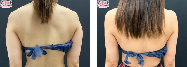 多田彩子医師|Aquicell(アキーセル)脂肪吸引、根こそぎVASER脂肪吸引|施術前後の症例写真