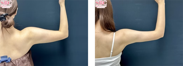 大須直人医師|根こそぎVASER脂肪吸引|施術前後の症例写真