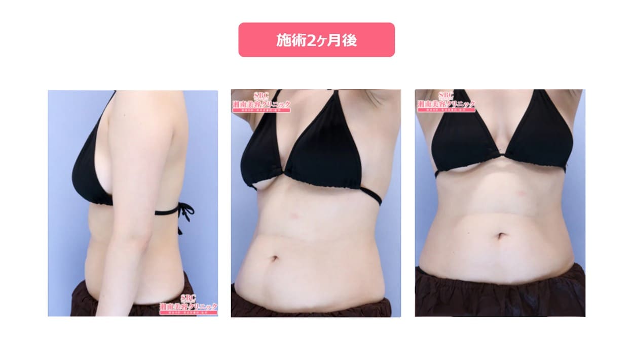 クールスカルプティング（クルスカダブル）上腹部の症例　アフター