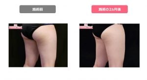 クールスカルプティング症例＿脚